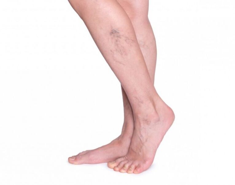 Varicose veins before treatment Varicone