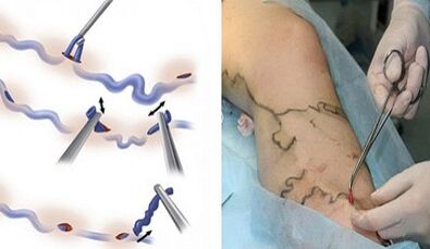 Flebectomy for varicose veins on the legs