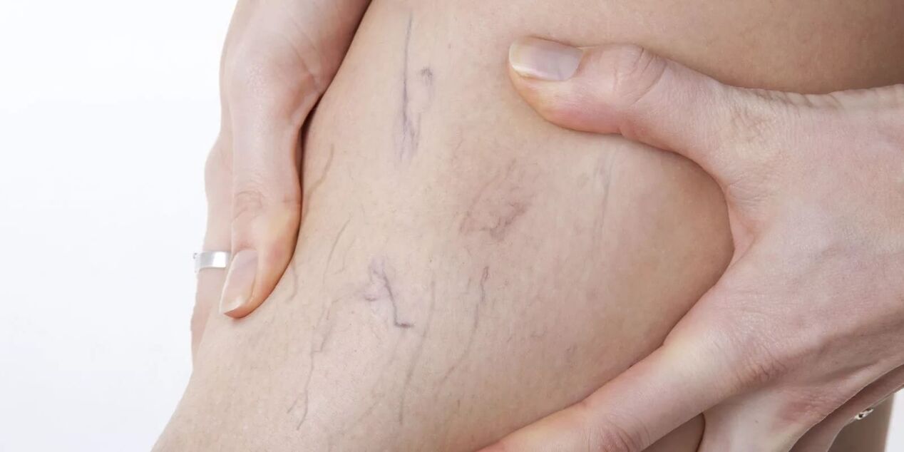 before the use of Varicone cream